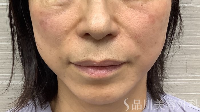 症例NO.62222のAFTER写真