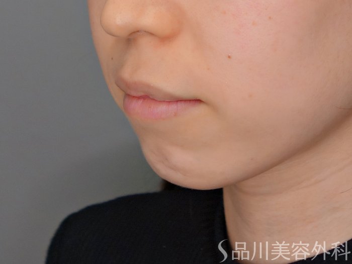 症例NO.69660のBEFORE写真