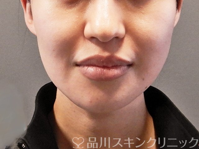 症例NO.64384のBEFORE写真