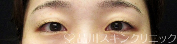症例NO.67743のBEFORE写真