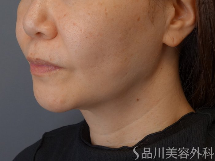 症例NO.72966のBEFORE写真