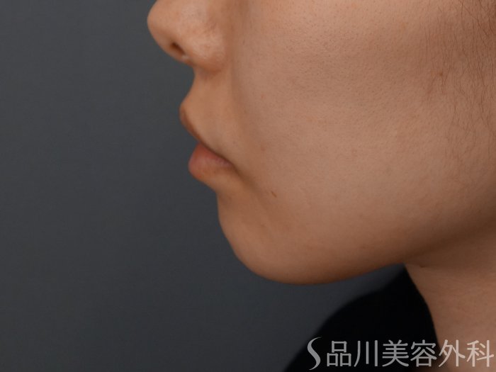 症例NO.69549のBEFORE写真