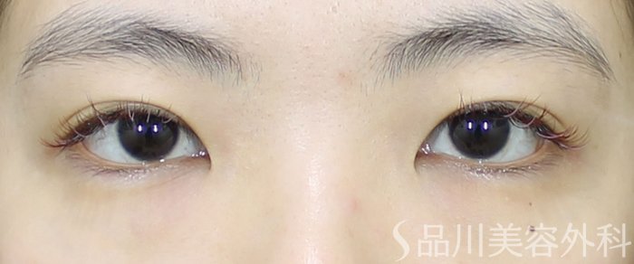 症例NO.72094のBEFORE写真