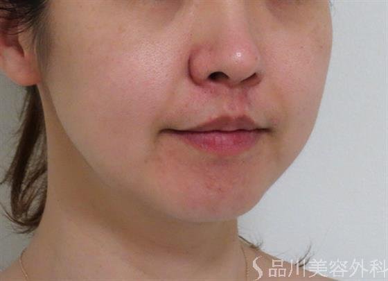 症例NO.39985のBEFORE写真