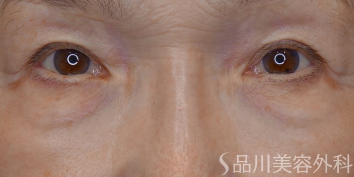 症例NO.72206のBEFORE写真