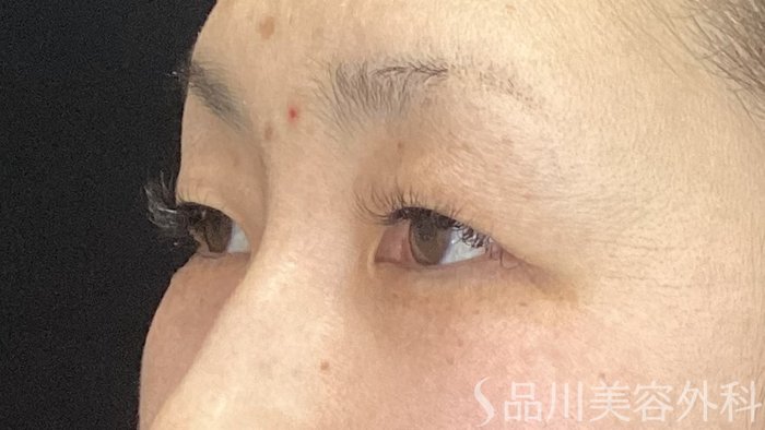 症例NO.74323のBEFORE写真