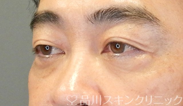 症例NO.65423のAFTER写真