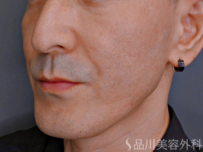 症例NO.73785のBEFORE写真