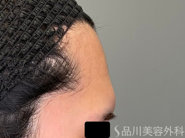 症例NO.71043のBEFORE写真