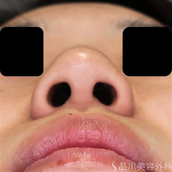 症例NO.50190のBEFORE写真