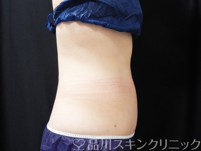 症例NO.74706のAFTER写真