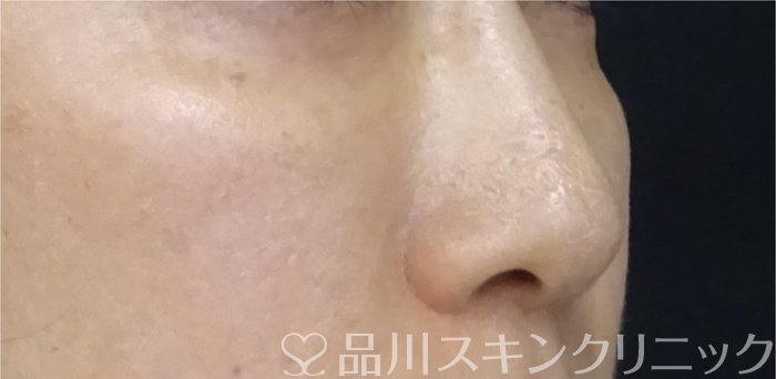 症例NO.69903のBEFORE写真