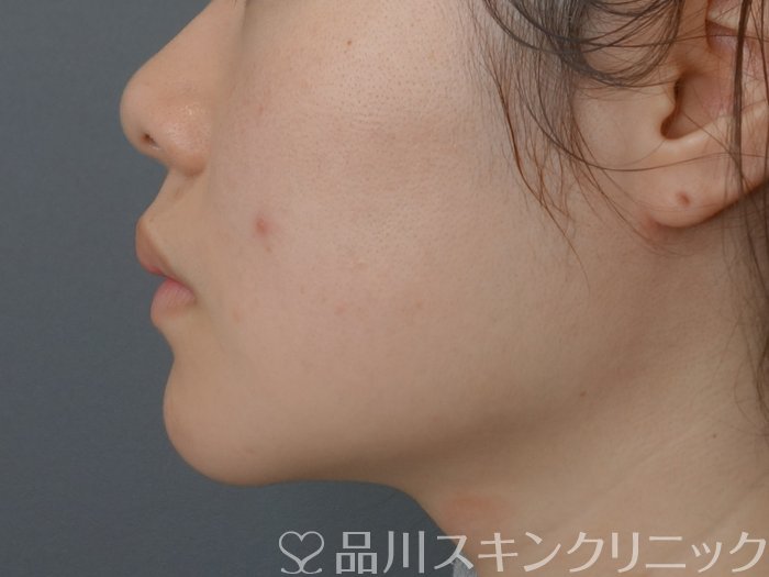 症例NO.73671のBEFORE写真