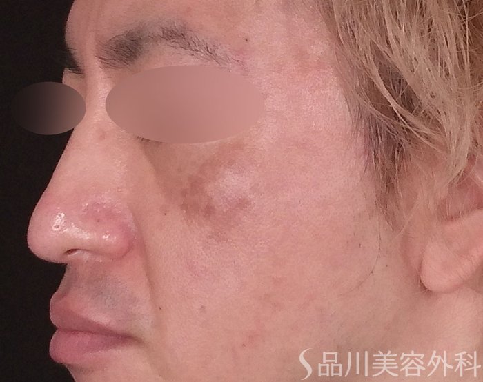 症例NO.72473のBEFORE写真