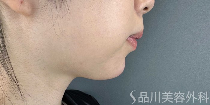 症例NO.65844のAFTER写真