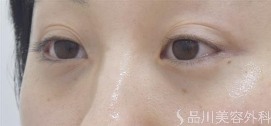症例NO.43838のBEFORE写真