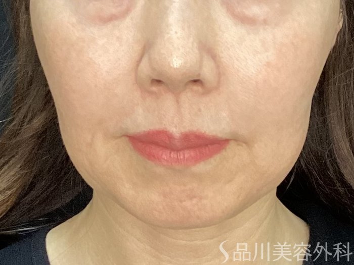 症例NO.72545のBEFORE写真