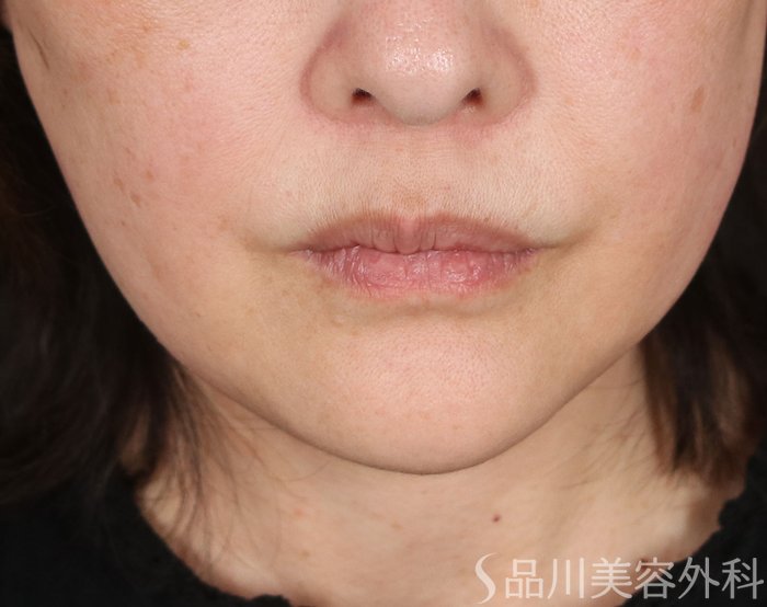 症例NO.73589のAFTER写真