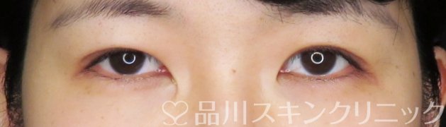 症例NO.67979のAFTER写真