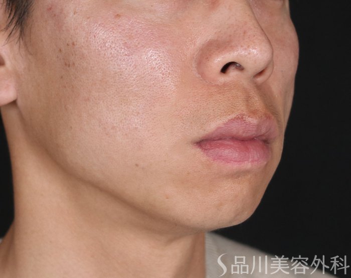 症例NO.73281のAFTER写真