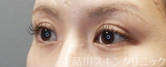 症例NO.72991のAFTER写真