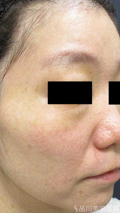 症例NO.65469のBEFORE写真