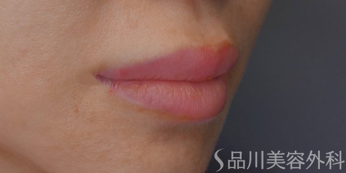 症例NO.71258のAFTER写真