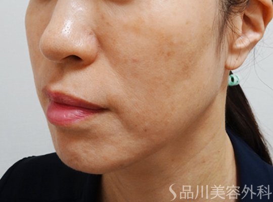 症例NO.73120のBEFORE写真