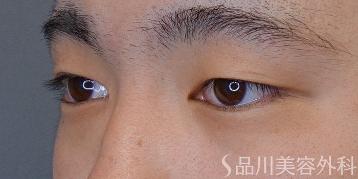 症例NO.73908のBEFORE写真