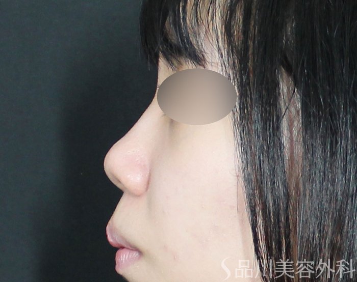 症例NO.72535のBEFORE写真