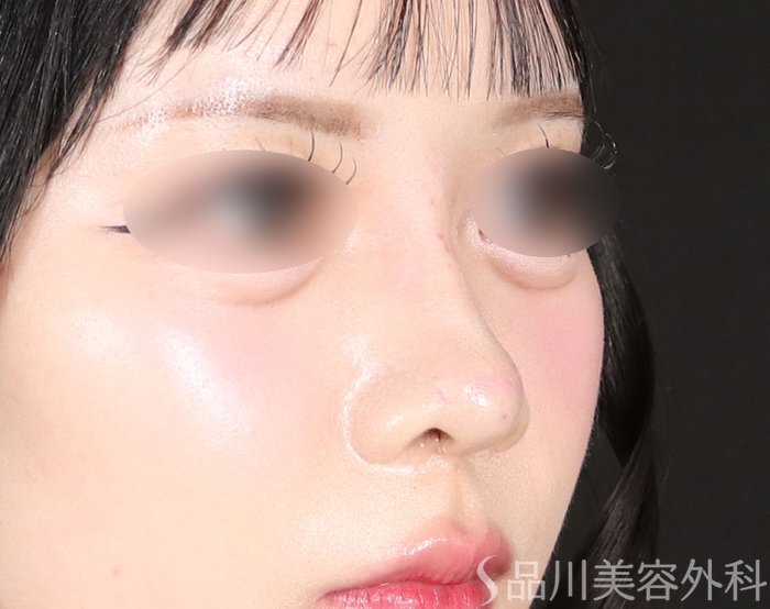 症例NO.74212のAFTER写真