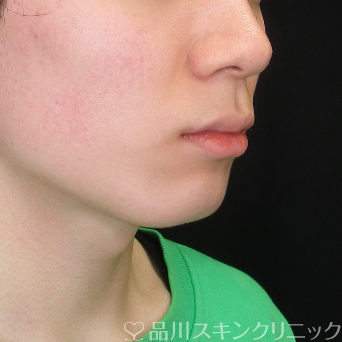 症例NO.73405のBEFORE写真