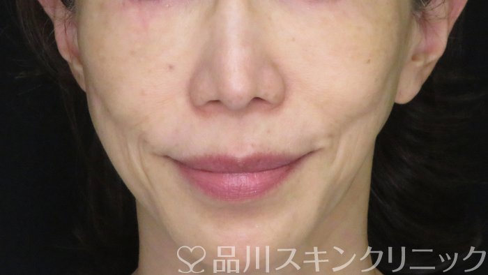 症例NO.71026のAFTER写真