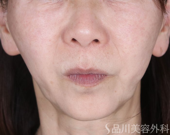 症例NO.72945のBEFORE写真