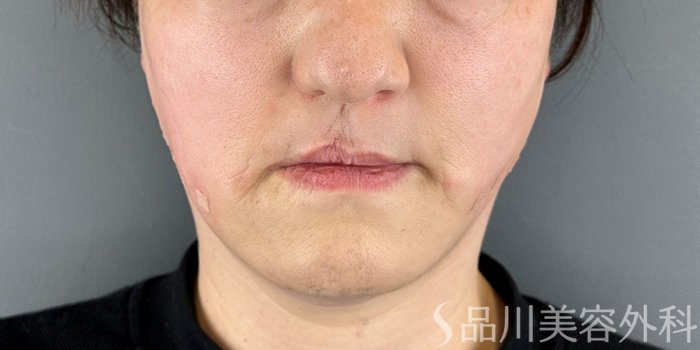 症例NO.73140のAFTER写真