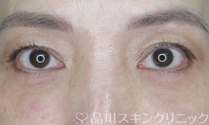 症例NO.63564のAFTER写真