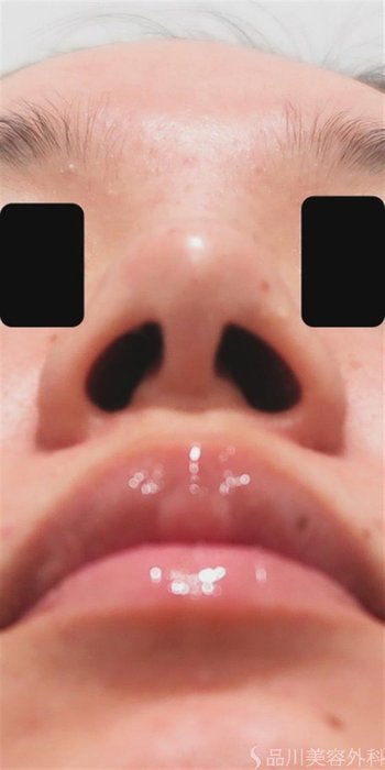 症例NO.44129のBEFORE写真