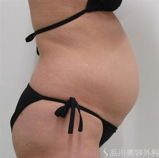 症例NO.43682のBEFORE写真