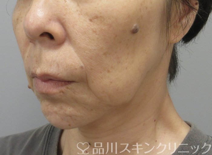 症例NO.73833のBEFORE写真