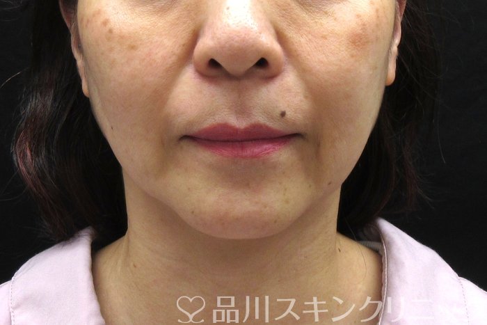 症例NO.74869のBEFORE写真