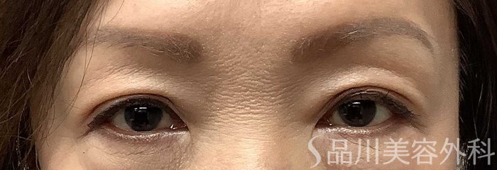 症例NO.62218のAFTER写真