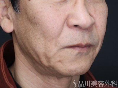 症例NO.73471のBEFORE写真