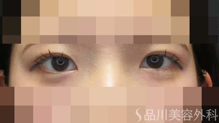 症例NO.71481のAFTER写真