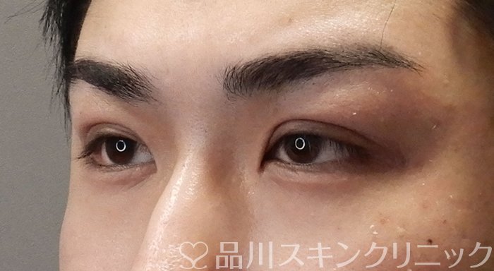 症例NO.70244のAFTER写真