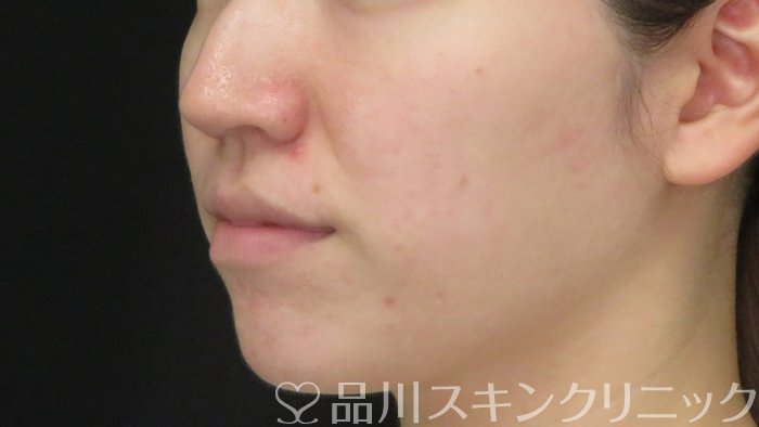 症例NO.71780のAFTER写真