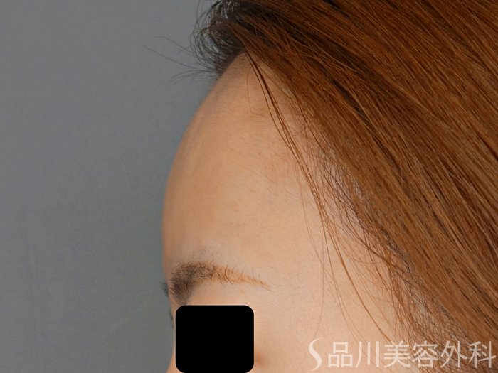 症例NO.69368のAFTER写真