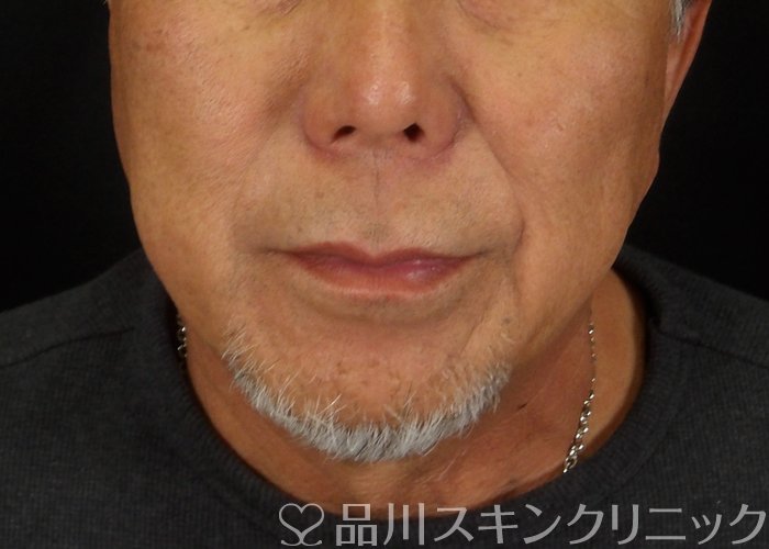 症例NO.70246のBEFORE写真