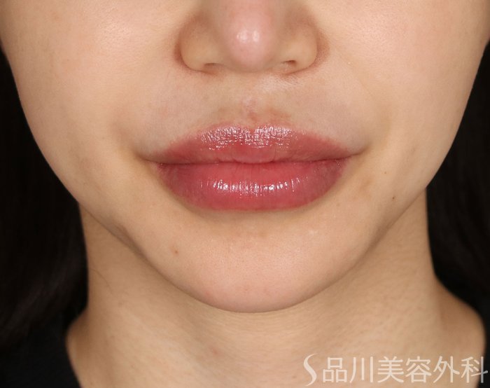 症例NO.73534のBEFORE写真