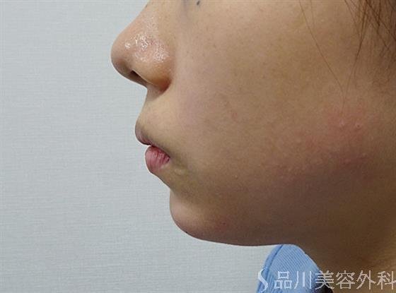 症例NO.52024のAFTER写真