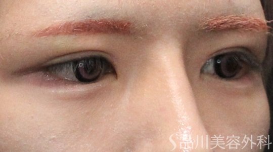症例NO.75213のAFTER写真